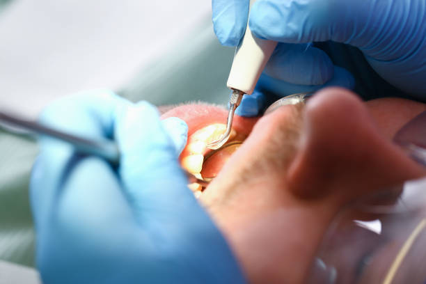 Best Emergency Dentist for Lost Fillings or Crowns in Kingston, PA